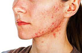 Tratamento para Acne