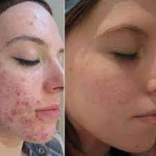 Tratamento para Acne